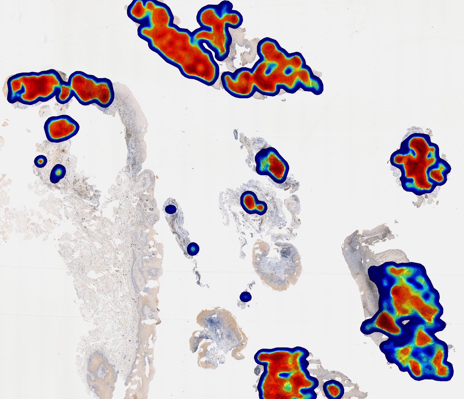 Algorithm output shown as a tumor-region heatmap