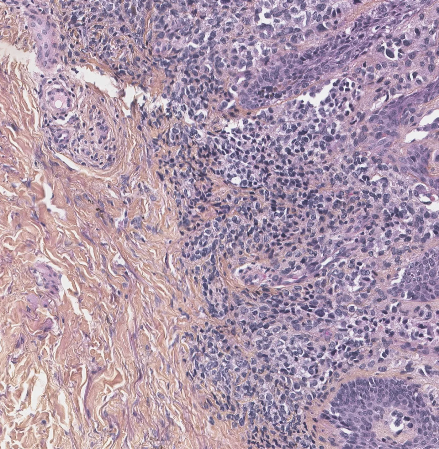 Melanoma histology, H&E